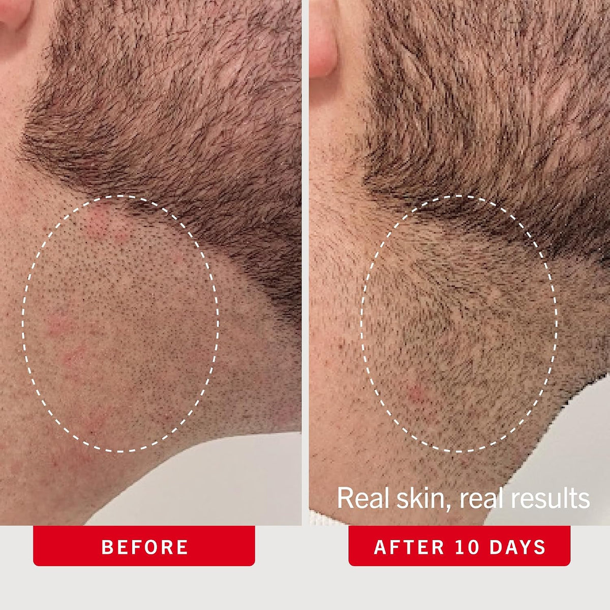 First Aid Beauty Ingrown Hair Pads with BHA and AHA